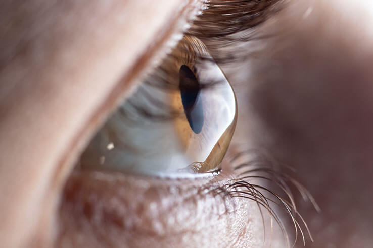 Closeup of an Eye With Keratoconus In Need of a Corneal Transplant