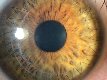 Closeup of an Eye That Has Had a Corneal Transplant